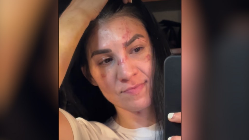 Irene Aldana shares healing update on insane cuts suffered at UFC 306