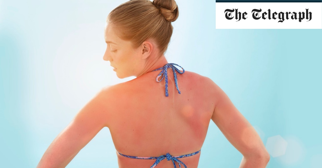 Suffering from sunburn? Here’s how to treat sore skin with home remedies