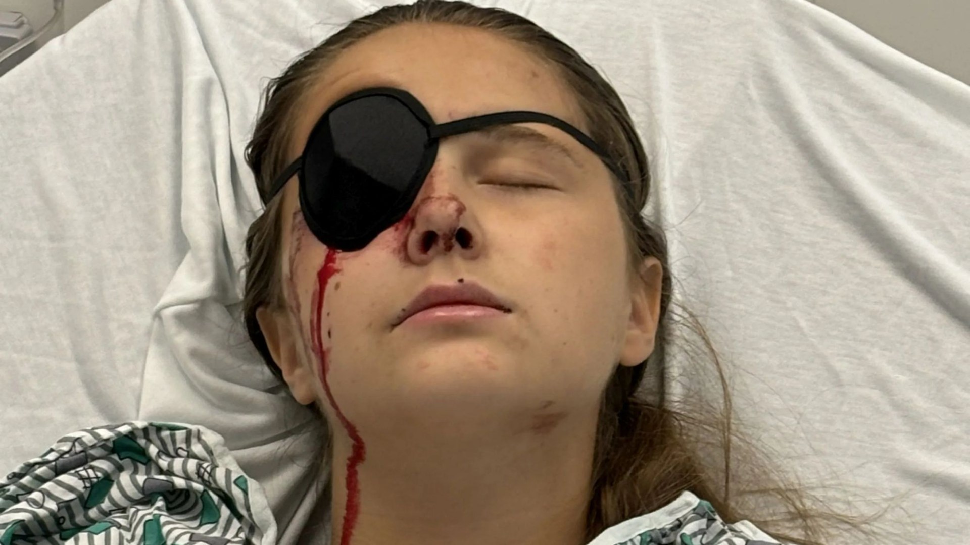 Schoolgirl's eye 'exploded like a grape' in freak car crash when she was driving at 'less than 10mph'