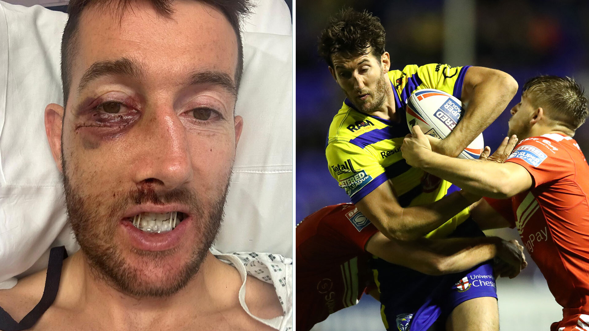 Rugby star facing 'numb face for rest of his life' after sickening injury left him with 11 fractures in his face