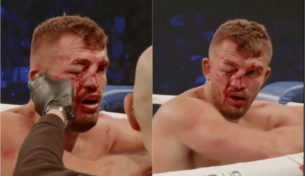 BKFC fighter’s face caves in resulting in doctor stoppage