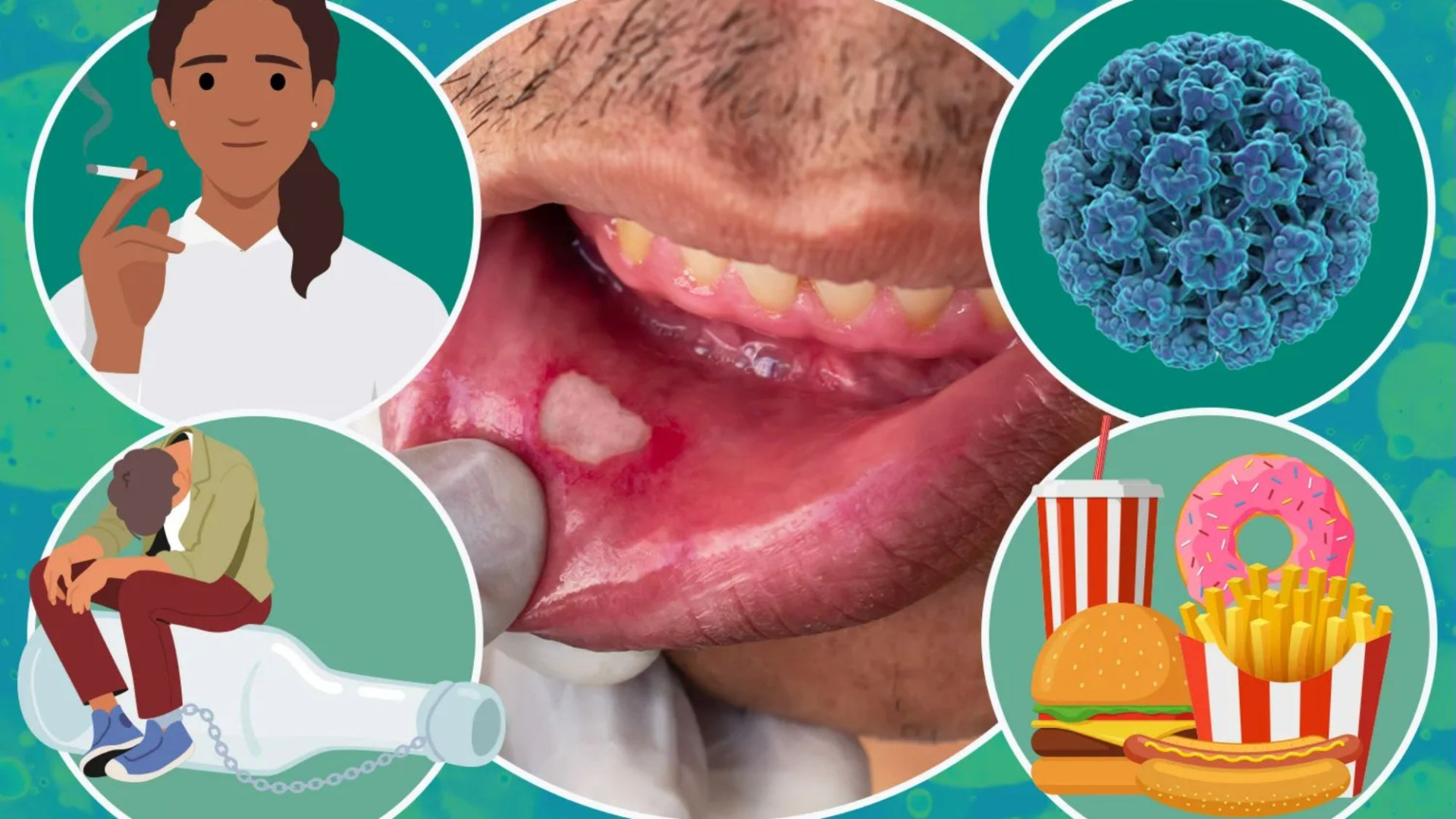 The 5 everyday habits that increase your risk of mouth cancer - and 8 signs you must never ignore