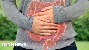 Bowel-cancer rates rising among younger people