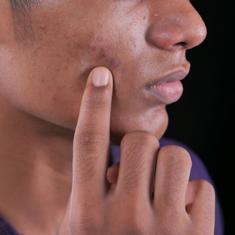 Hidradenitis Suppurativa: Symptoms, Treatments & More