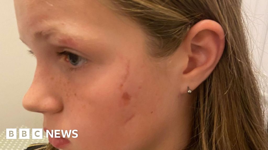 Pet insurance law call after Bridgend girl left scarred