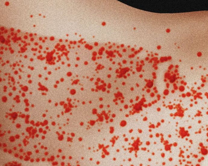 Scientists Find Measles Likely To Become Endemic in the US Over Next 20 Years