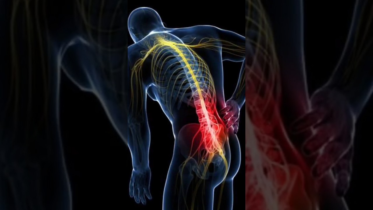 physiotherapy sessions #sciatica   #physiotherapy  #physiotherapist #motivation