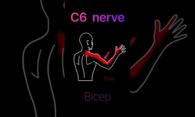 pinched nerve in the neck? #shorts