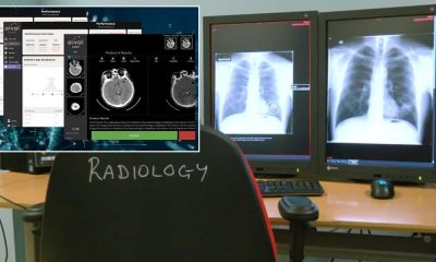 NHS Scotland launches AI trial to help detect lung cancer and strokes in X-rays