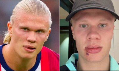 Erling Haaland suffers freak facial injury on Norway team bus