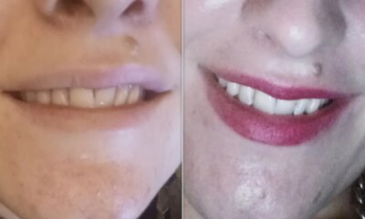 The Best Tooth Whitening Kit Black Friday Sale We've Seen