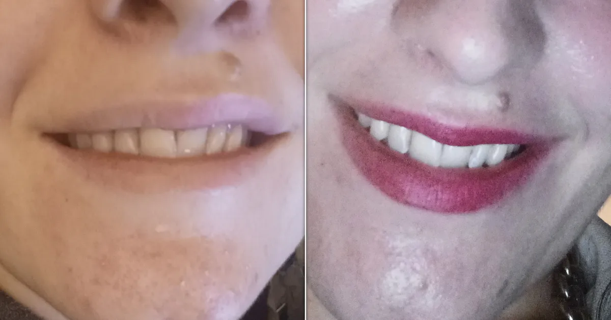 The Best Tooth Whitening Kit Black Friday Sale We've Seen