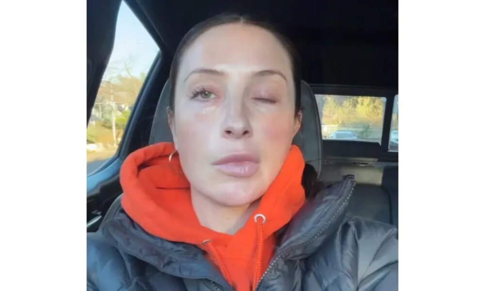 Bristol Palin Says Face Is 'Still Crooked' 1 Year After Paralysis