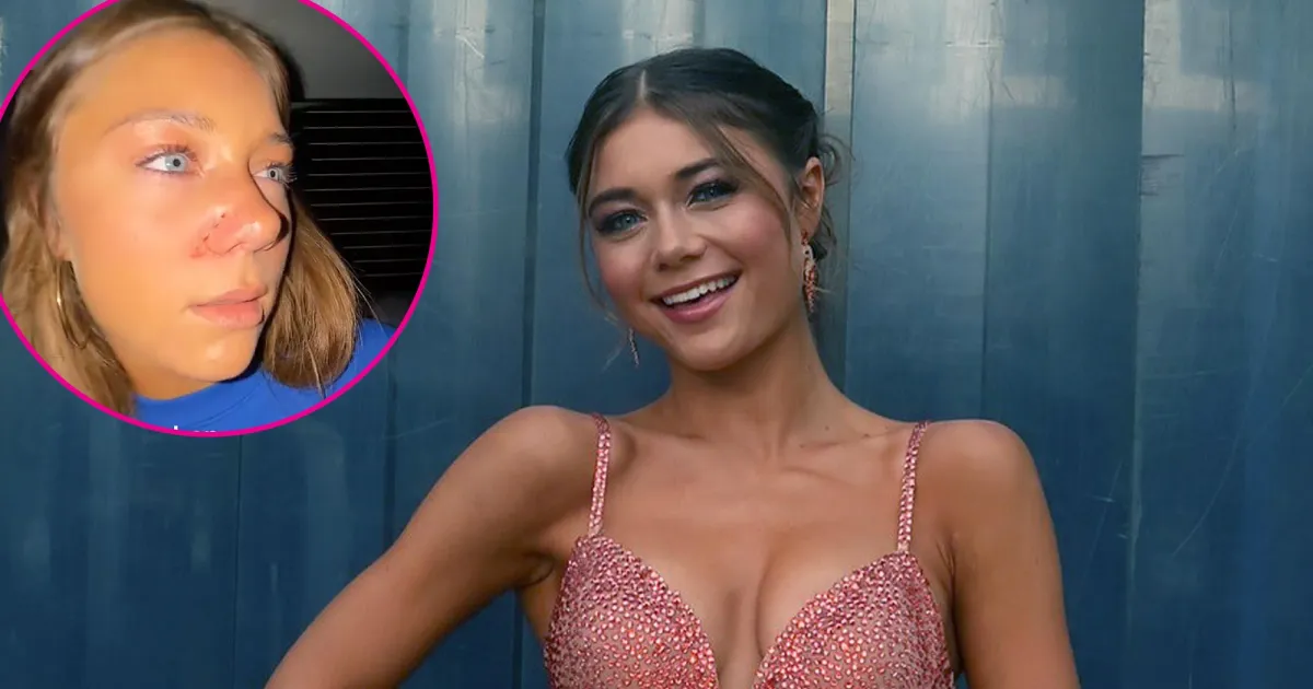 DWTS' Hailey Bills Has Possible Broken Nose After Thanksgiving Injury