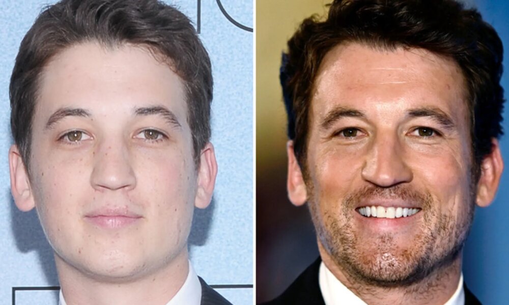 Miles Teller -- Good Genes or Good Docs?!