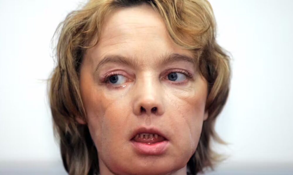 A stranger’s face? The unresolved questions of face transplantation 20 years on