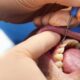 Dentist warns of common habit that could cause gum disease