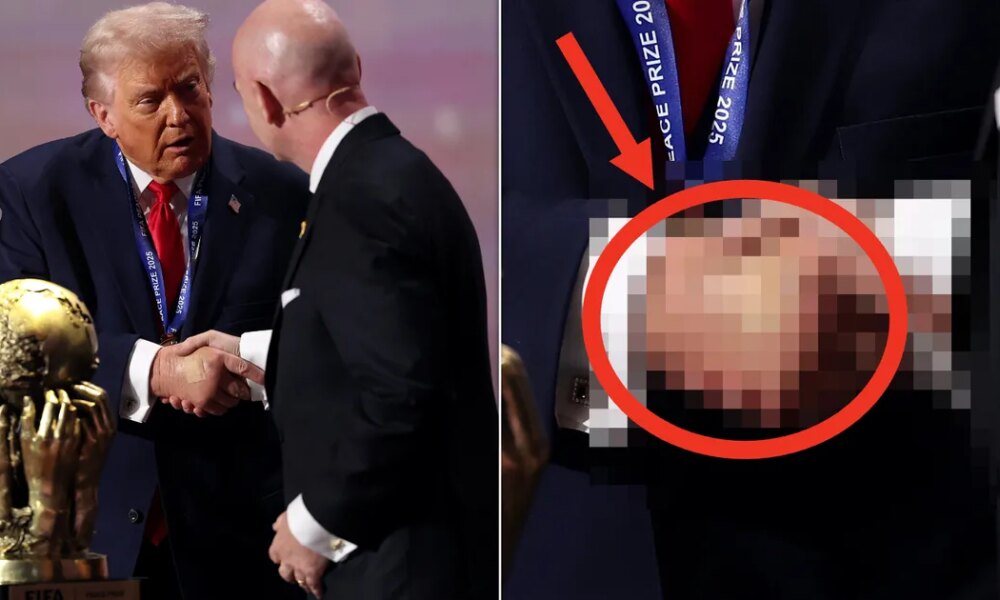 Trump's Bruised Hand Is Looking Pretty Swollen