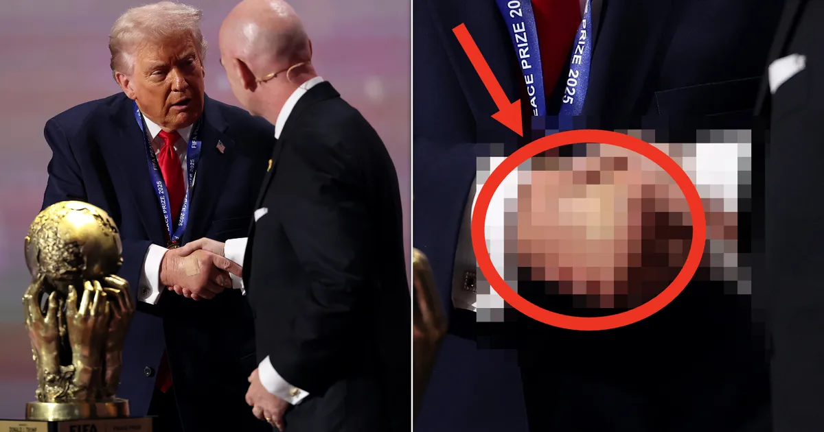 Trump's Bruised Hand Is Looking Pretty Swollen