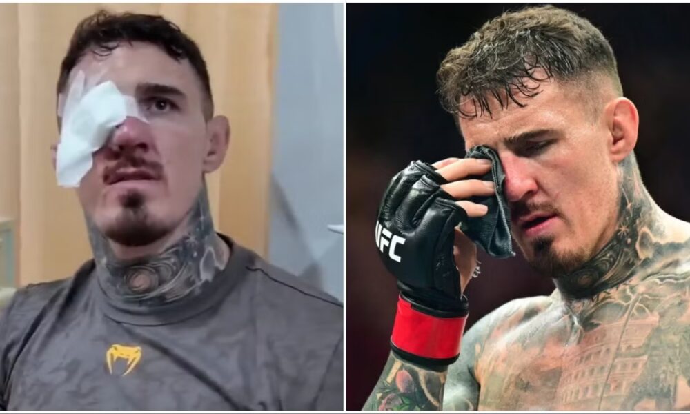 What is Bilateral Brown's Syndrome?