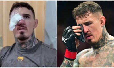 What is Bilateral Brown's Syndrome?