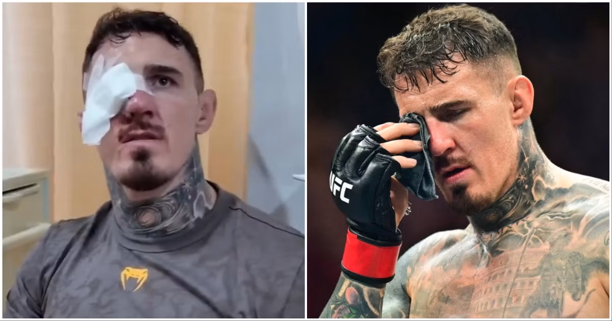 What is Bilateral Brown's Syndrome?