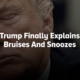 Trump Finally Explains Bruises And Snoozes