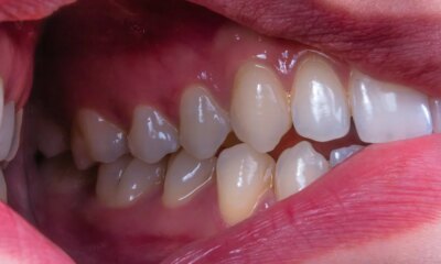 Why Your Spit Could Hold The Future Of Cavity Prevention