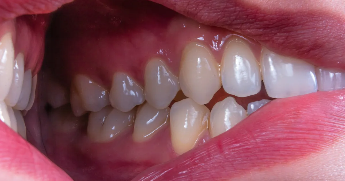 Why Your Spit Could Hold The Future Of Cavity Prevention