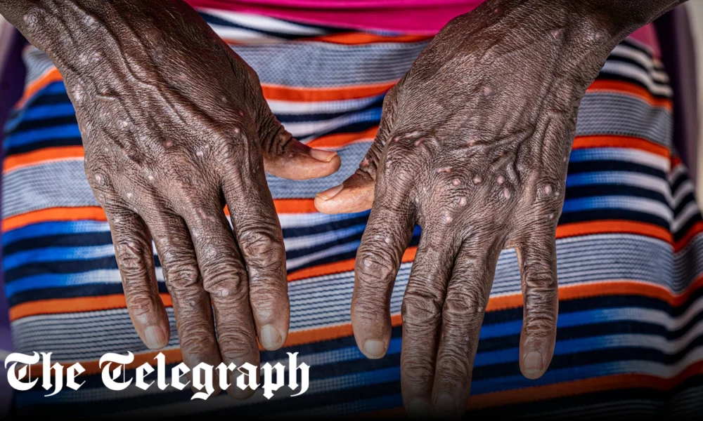 Mpox may be spreading asymptomatically, greatly increasing its threat, finds new study
