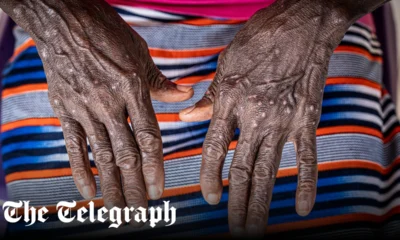 Mpox may be spreading asymptomatically, greatly increasing its threat, finds new study