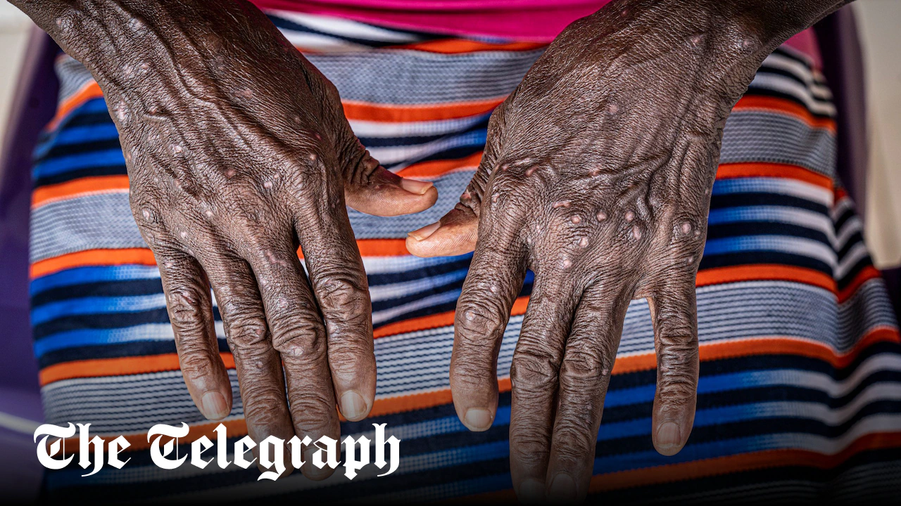 Mpox may be spreading asymptomatically, greatly increasing its threat, finds new study