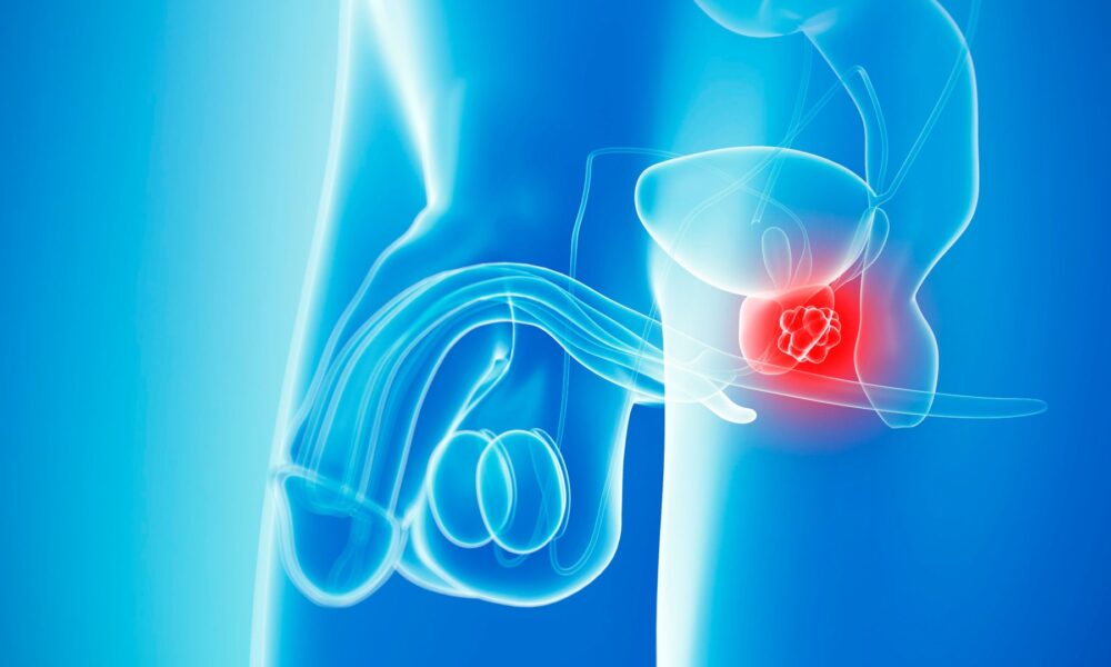 Prostate cancer overtakes breast as most common form of the disease