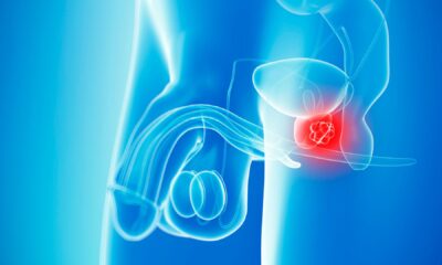 Prostate cancer overtakes breast as most common form of the disease