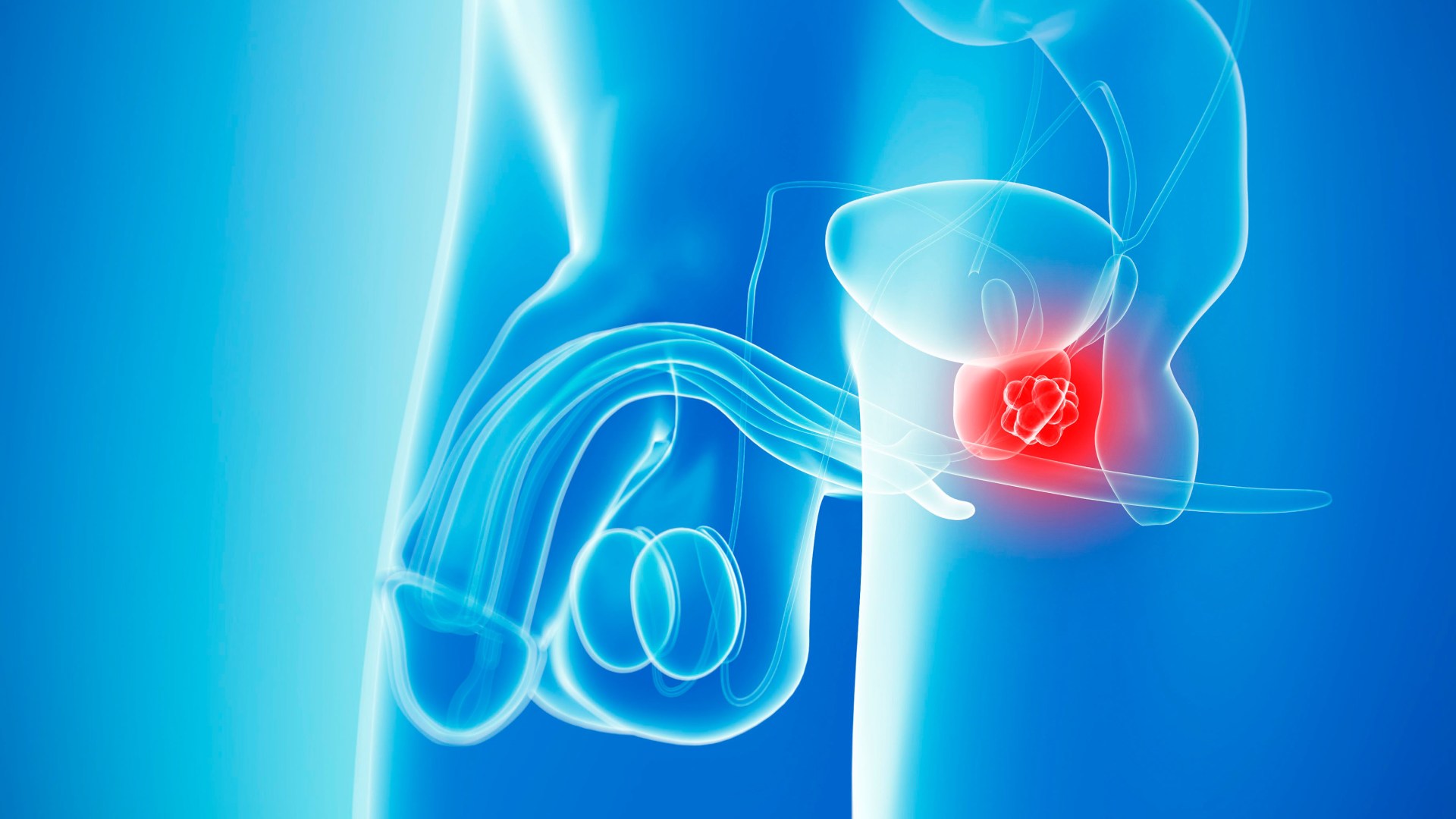 Prostate cancer overtakes breast as most common form of the disease
