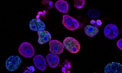 Revolutionary therapy treats ‘untreatable’ blood cancer