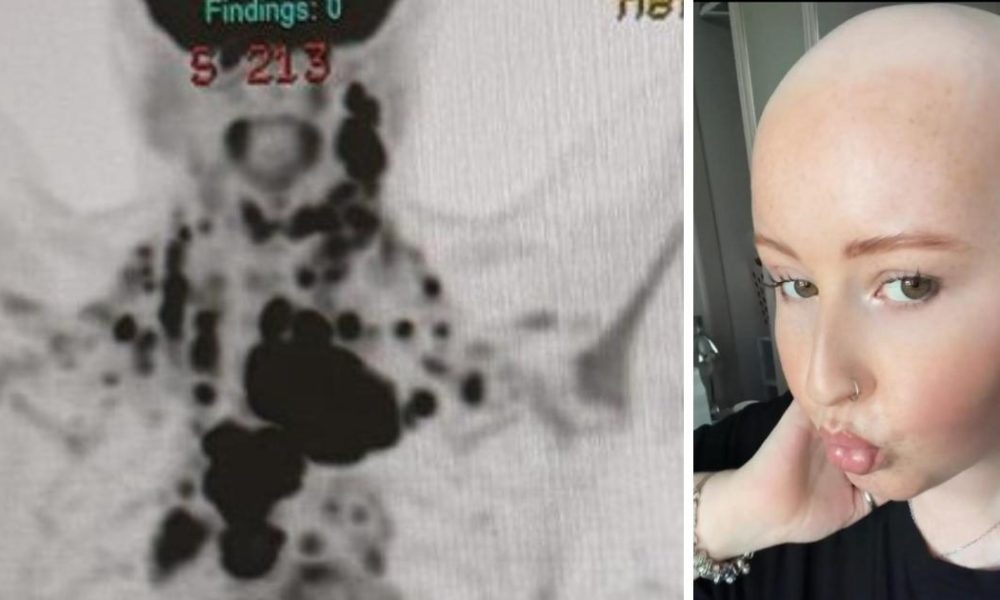 Chester-le-Street 22-year-old diagnosed with stage 4 cancer