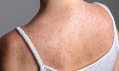 Measles symptoms you should know and when to call 999