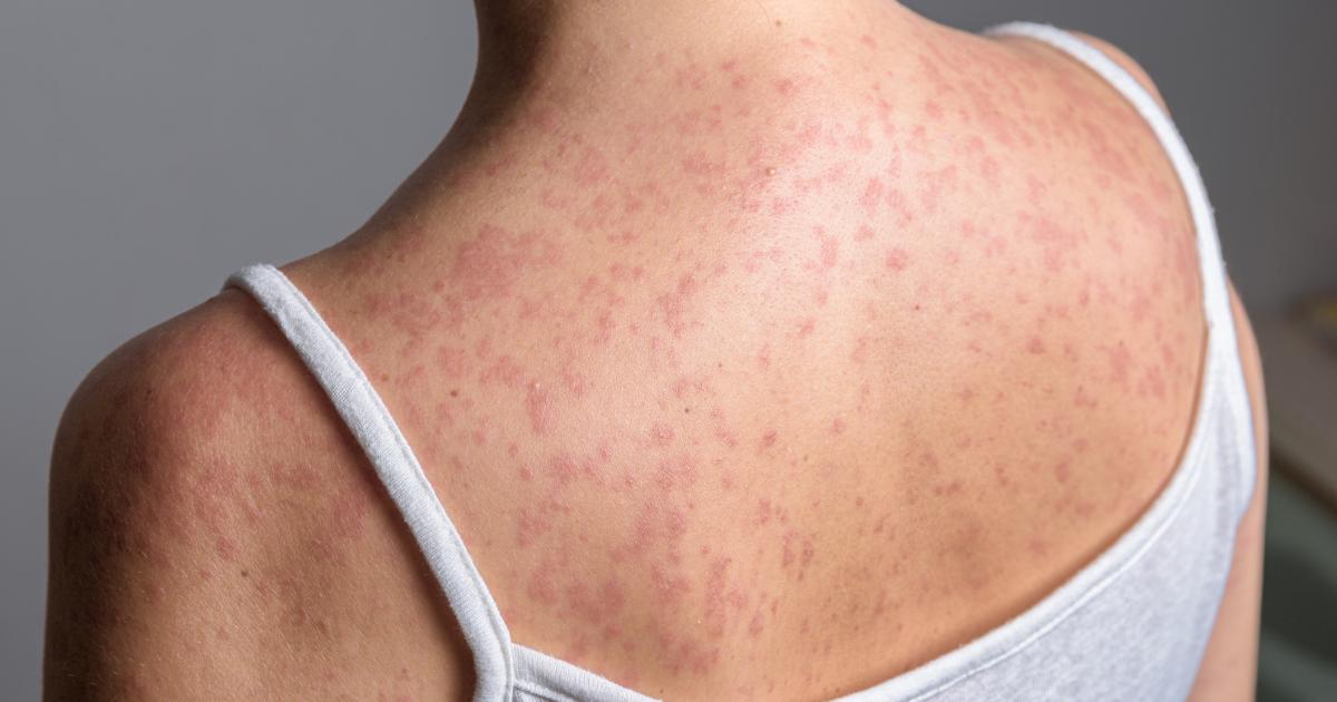 Measles symptoms you should know and when to call 999