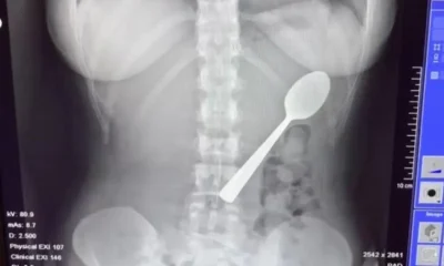 Woman could feel 17cm spoon ‘moving inside of her’ after accidentally swallowing it | News World