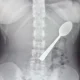 Woman could feel 17cm spoon ‘moving inside of her’ after accidentally swallowing it | News World
