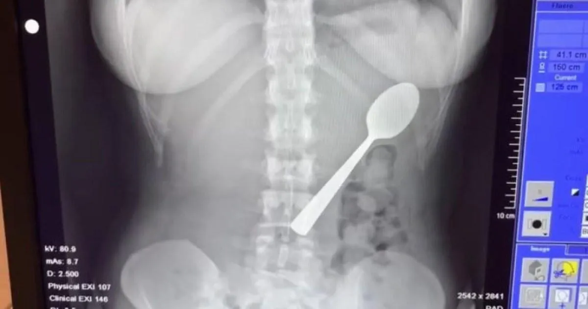 Woman could feel 17cm spoon ‘moving inside of her’ after accidentally swallowing it | News World
