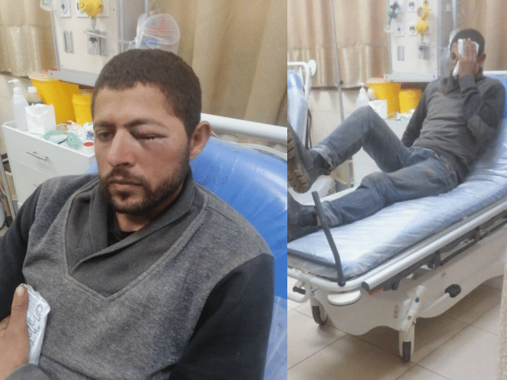 Two photos side by side: a Palestinian man in hospital whose left eye is swollen shit and another photo of him in bed holding what appears to be an ice pack over his eye