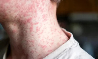 At least 80 children have been infected with measles in just one London borough | News UK