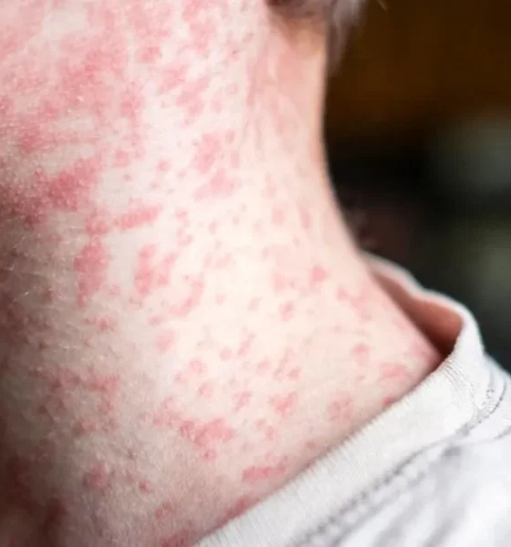 At least 80 children have been infected with measles in just one London borough | News UK