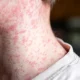 At least 80 children have been infected with measles in just one London borough | News UK