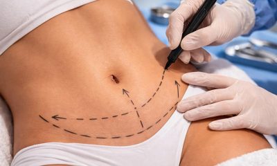 Tummy Tuck and Liposuction After Weight Changes