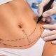 Tummy Tuck and Liposuction After Weight Changes