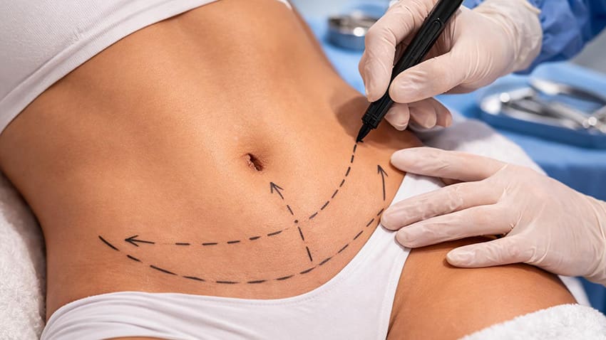 Tummy Tuck and Liposuction After Weight Changes