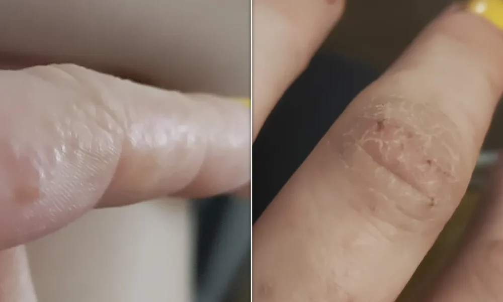 What Tiny Itchy Bumps On Your Hands And Feet Mean And How To Treat Them
